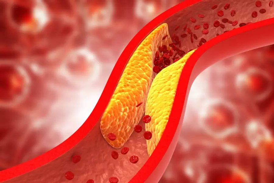 Breaking News: Cholesterol’s Role in Heart Health Debated Once Again